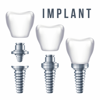 dental implants diagram